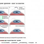 Иллюстрация №2: Лазерная коррекция зрения с учетом оптики глаза (Курсовые работы - Медицина, Физика).