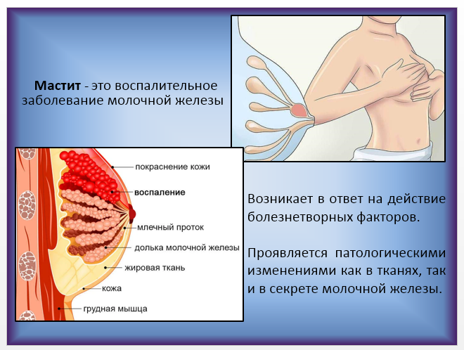 Мастит сестринский уход. Сестринский уход при мастите. Сестринский уход при мастите у женщин. 1. Сестринский уход при мастите.