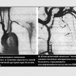 Иллюстрация №2: Системные васкулиты у детейНеспецифический аортоартериит, Синдром Кавасаки (Презентации - Медицина).