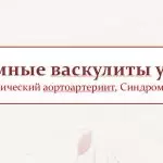 Иллюстрация №1: Системные васкулиты у детейНеспецифический аортоартериит, Синдром Кавасаки (Презентации - Медицина).