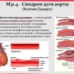 Иллюстрация №3: Системные васкулиты у детейНеспецифический аортоартериит, Синдром Кавасаки (Презентации - Медицина).